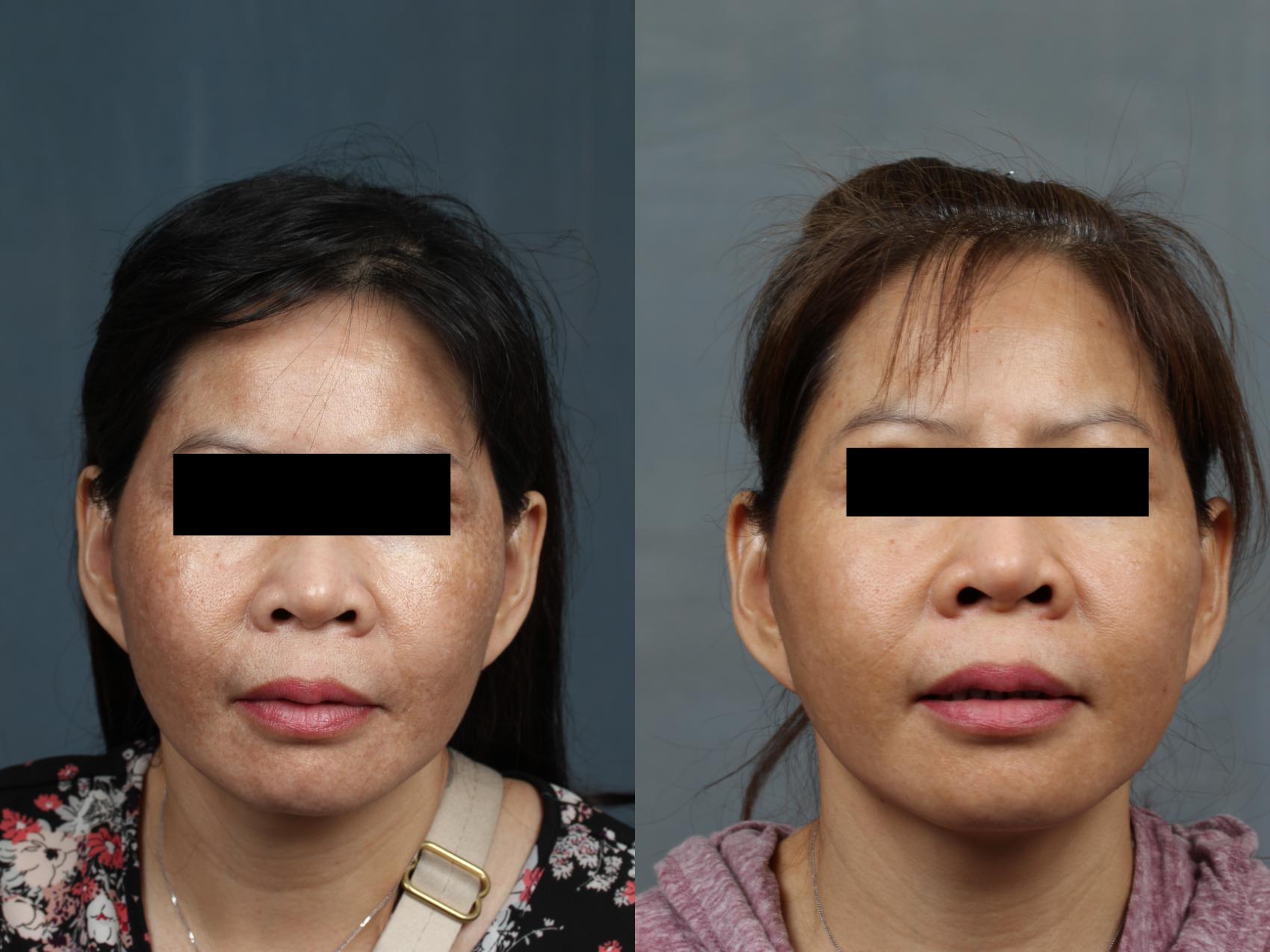Advanced Medical Facials Case 678 Before & After Front | Louisville, KY | CaloSpa® Rejuvenation Center