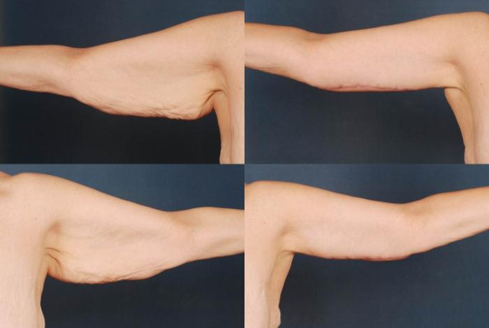 Before & After Arm Lift Case 231 View #1 View in Louisville & Lexington, KY