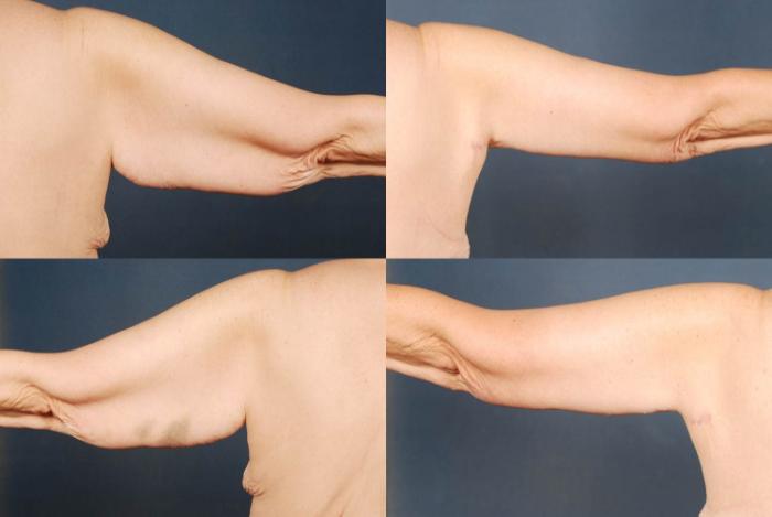 Before & After Arm Lift Case 231 View #2 View in Louisville & Lexington, KY