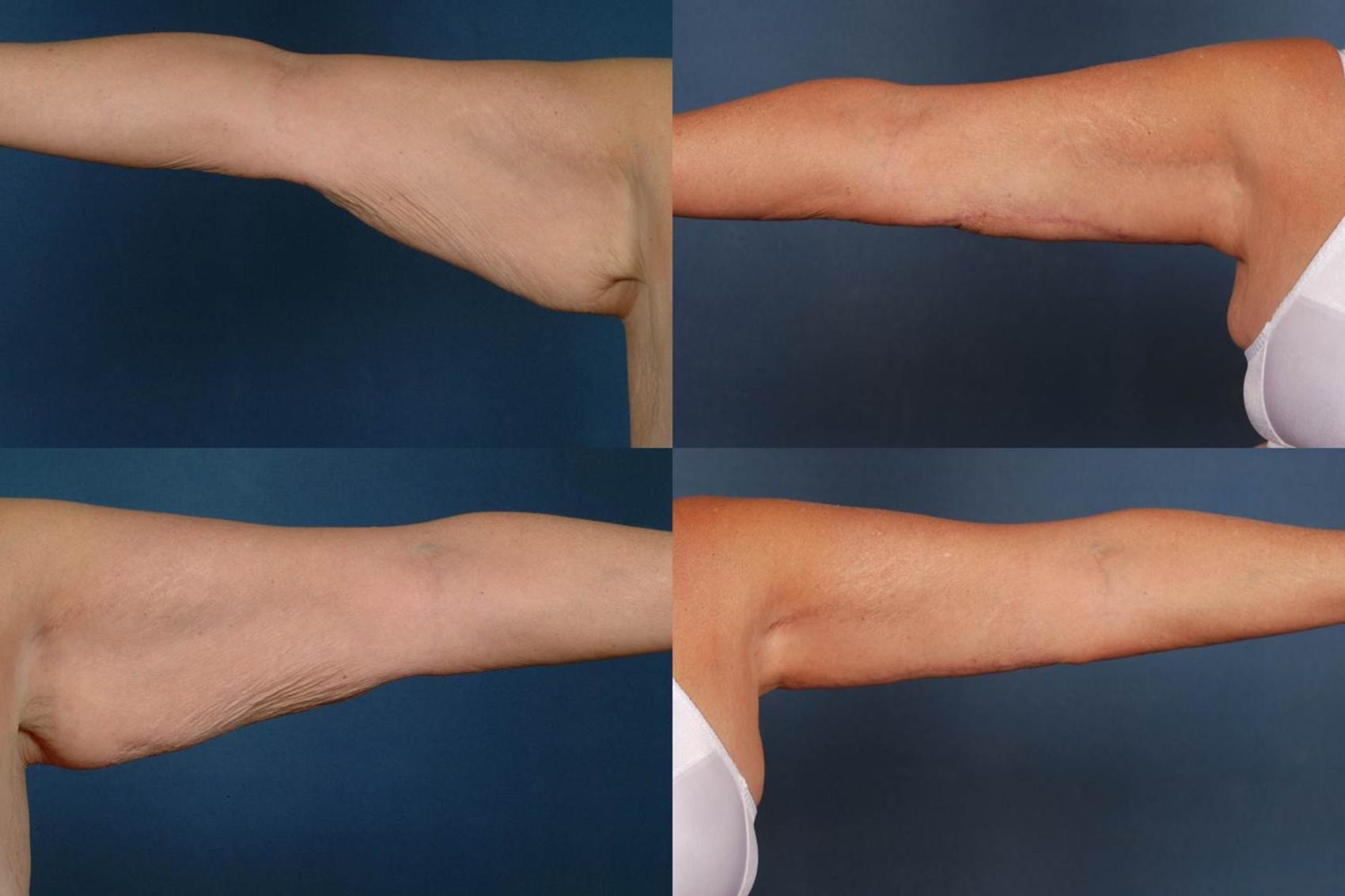 Before & After Arm Lift Case 232 View #1 View in Louisville & Lexington, KY