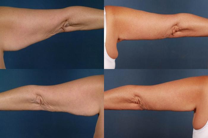 Before & After Arm Lift Case 232 View #2 View in Louisville & Lexington, KY