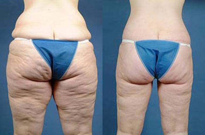 Before & After Body/Thigh Lift Case 137 View #2 View in Louisville & Lexington, KY