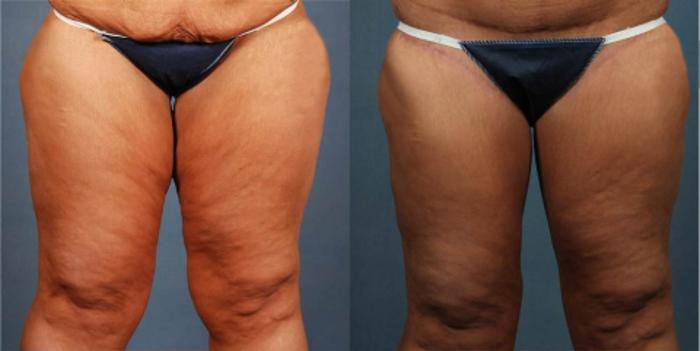Before & After Body/Thigh Lift Case 247 View #3 View in Louisville & Lexington, KY