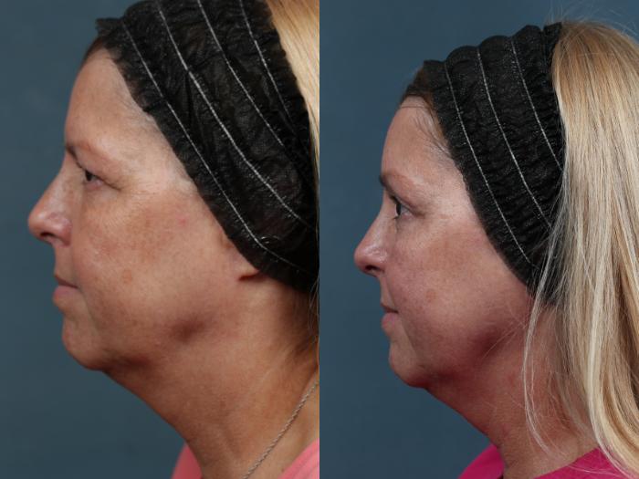 Before & After Brow/Forehead Lift Case 499 View #3 View in Louisville & Lexington, KY