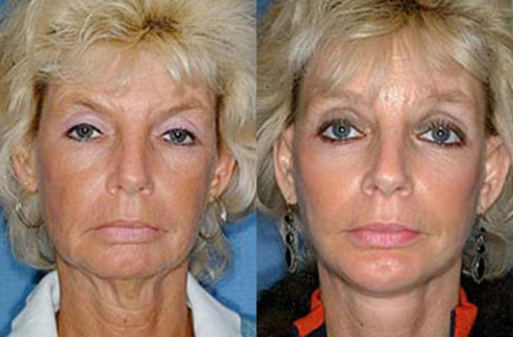 Before & After Brow/Forehead Lift Case 72 View #1 View in Louisville & Lexington, KY