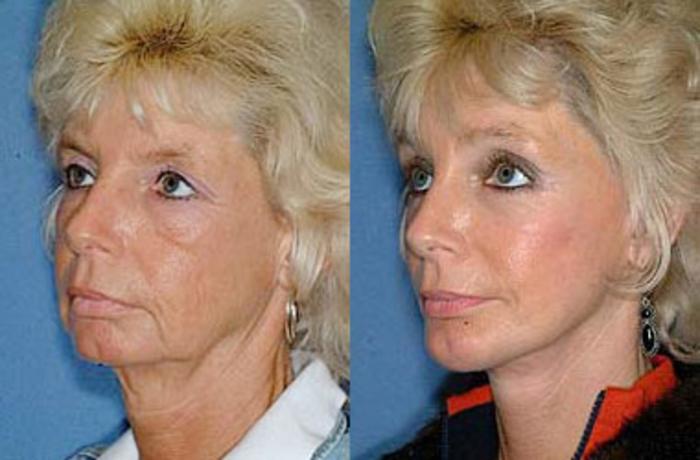 Before & After Brow/Forehead Lift Case 72 View #2 View in Louisville & Lexington, KY