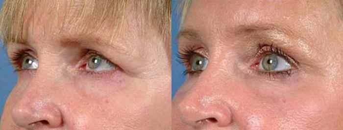 Before & After Brow/Forehead Lift Case 73 View #2 View in Louisville & Lexington, KY