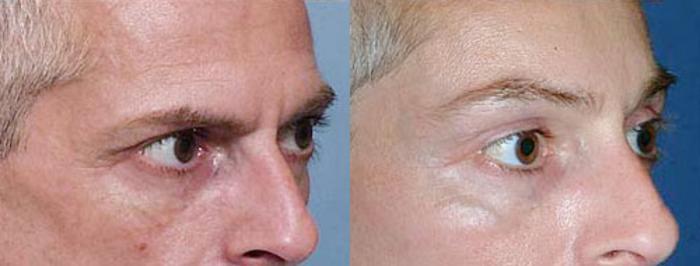 Before & After Brow/Forehead Lift Case 75 View #2 View in Louisville & Lexington, KY
