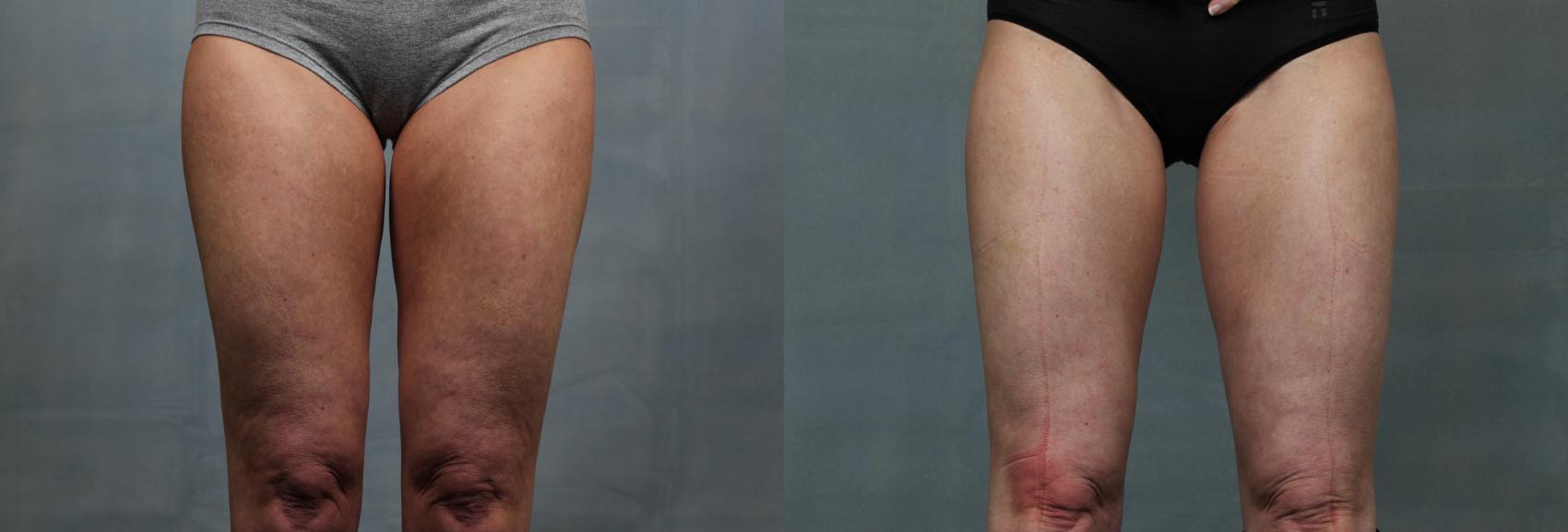 Cellulite Treatments Case 616 Before & After Front | Louisville, KY | CaloSpa® Rejuvenation Center