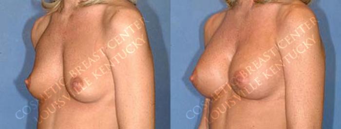 Before & After Enlargement - Saline Case 1 View #2 View in Louisville & Lexington, KY