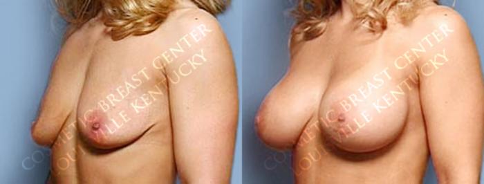 Before & After Enlargement - Saline Case 14 View #2 View in Louisville & Lexington, KY