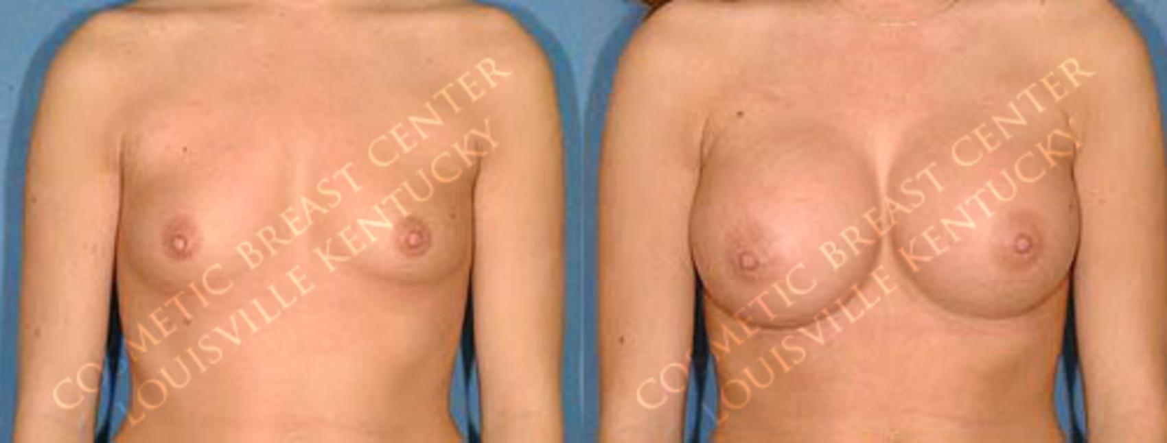 Before & After Enlargement - Saline Case 16 View #1 View in Louisville & Lexington, KY