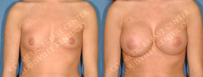 Before & After Enlargement - Saline Case 16 View #1 View in Louisville & Lexington, KY