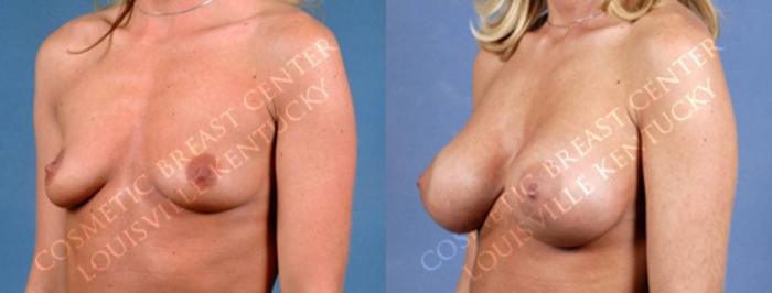 Before & After Enlargement - Saline Case 167 View #2 View in Louisville & Lexington, KY