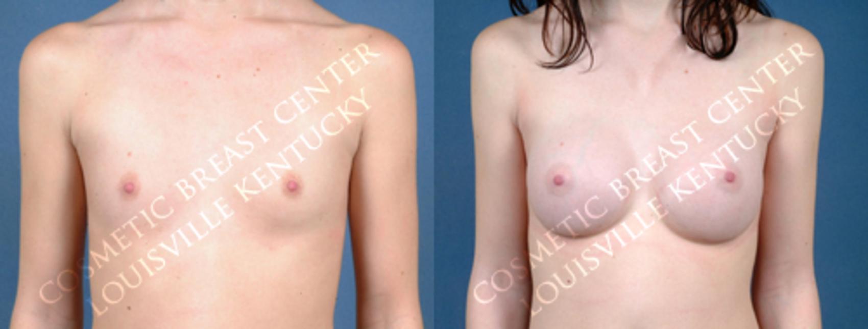 Before & After Enlargement - Saline Case 168 View #1 View in Louisville & Lexington, KY
