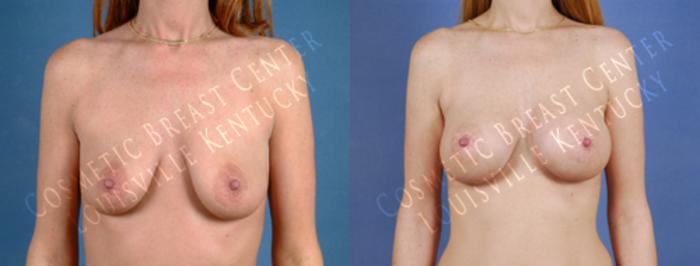 Before & After Enlargement - Saline Case 177 View #1 View in Louisville & Lexington, KY