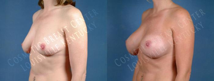 Before & After Enlargement - Saline Case 178 View #2 View in Louisville & Lexington, KY