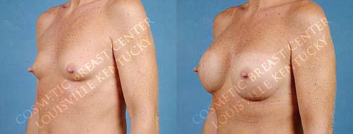 Before & After Enlargement - Saline Case 18 View #2 View in Louisville & Lexington, KY