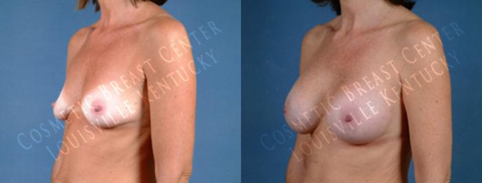 Before & After Enlargement - Saline Case 187 View #2 View in Louisville & Lexington, KY