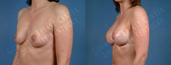 Before & After Enlargement - Saline Case 189 View #2 View in Louisville & Lexington, KY