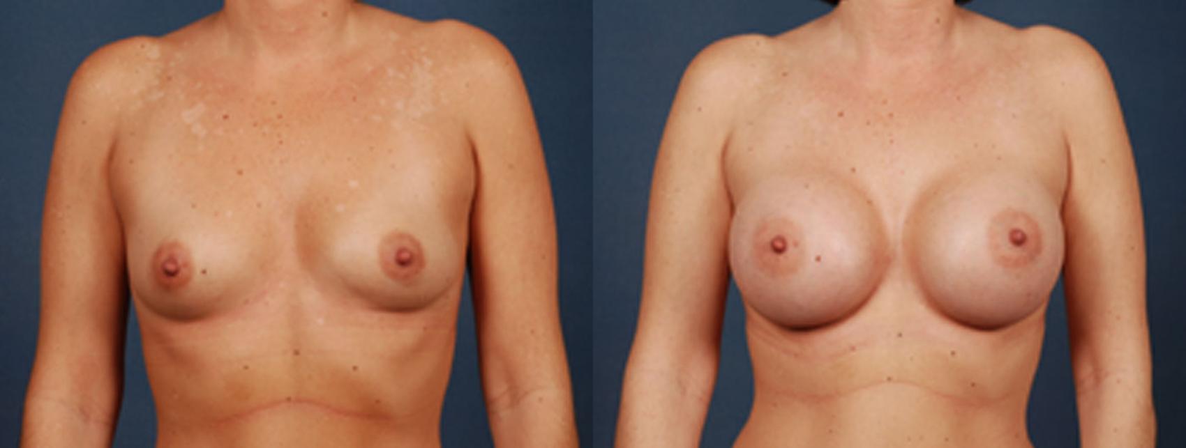 Before & After Enlargement - Saline Case 191 View #1 View in Louisville & Lexington, KY