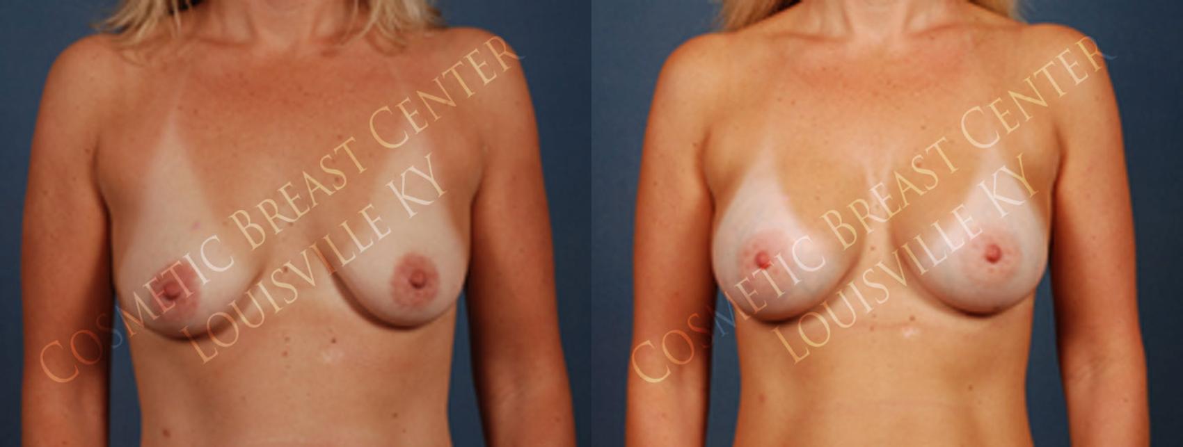 Before & After Enlargement - Saline Case 196 View #1 View in Louisville & Lexington, KY