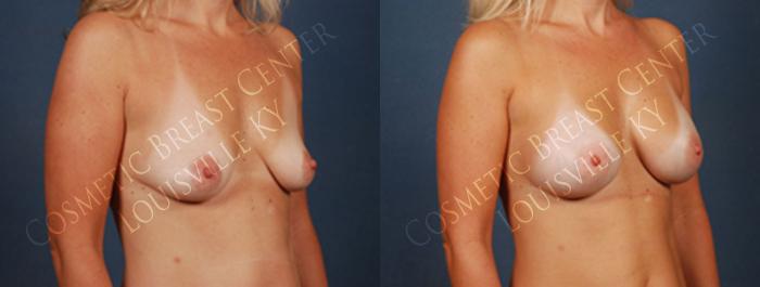 Before & After Enlargement - Saline Case 196 View #2 View in Louisville & Lexington, KY