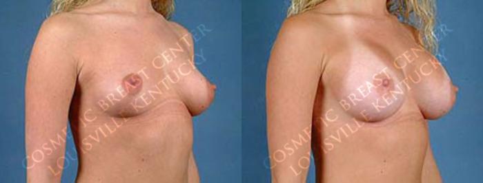 Before & After Enlargement - Saline Case 2 View #2 View in Louisville & Lexington, KY