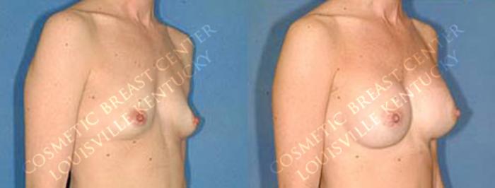 Before & After Enlargement - Saline Case 20 View #2 View in Louisville & Lexington, KY