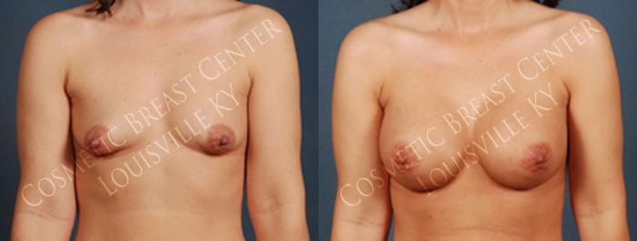 Before & After Enlargement - Saline Case 216 View #1 View in Louisville & Lexington, KY
