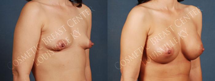 Before & After Enlargement - Saline Case 216 View #2 View in Louisville & Lexington, KY