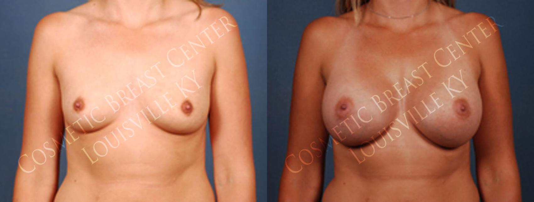 Before & After Enlargement - Saline Case 230 View #1 View in Louisville & Lexington, KY
