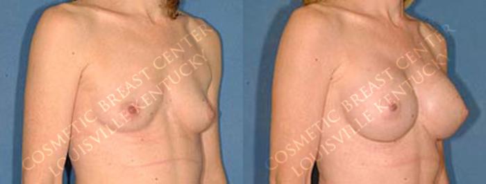 Before & After Enlargement - Saline Case 24 View #2 View in Louisville & Lexington, KY