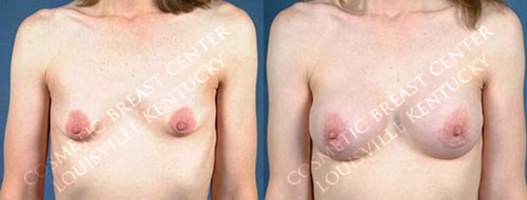 Before & After Enlargement - Saline Case 29 View #1 View in Louisville & Lexington, KY