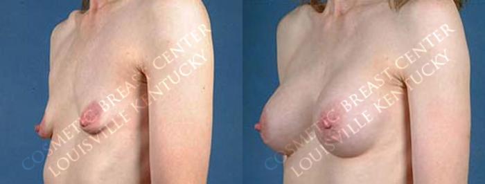 Before & After Enlargement - Saline Case 29 View #2 View in Louisville & Lexington, KY