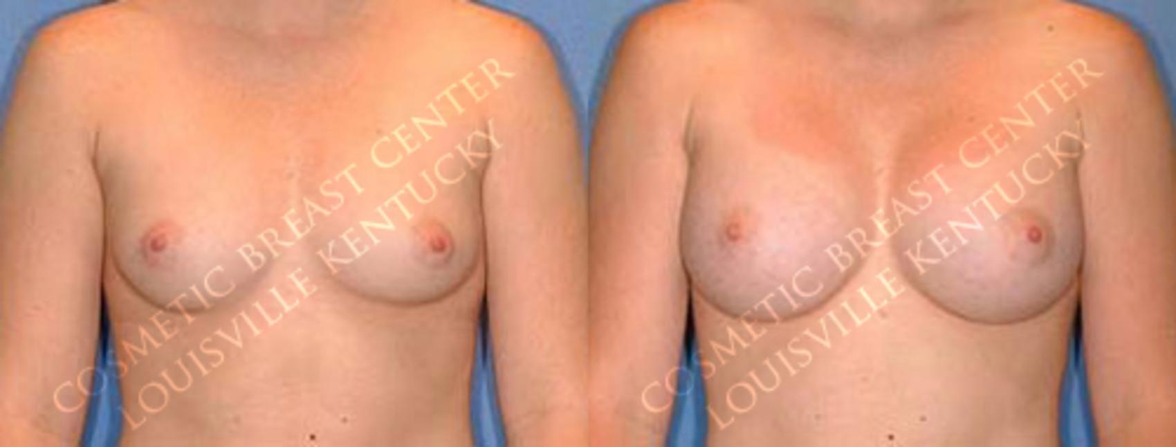 Before & After Enlargement - Saline Case 7 View #1 View in Louisville & Lexington, KY