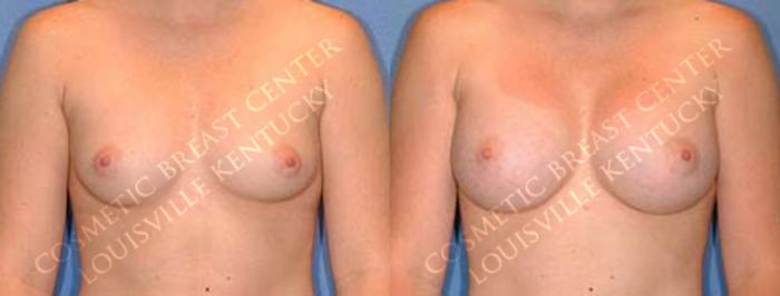 Before & After Enlargement - Saline Case 7 View #1 View in Louisville & Lexington, KY