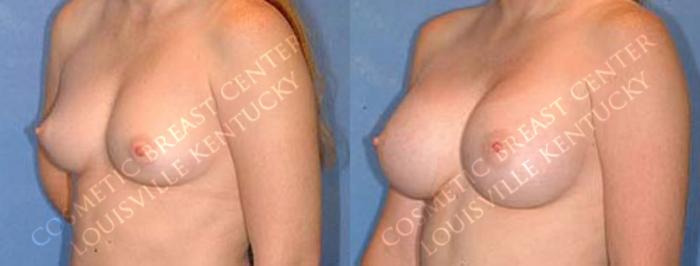 Before & After Enlargement - Saline Case 7 View #2 View in Louisville & Lexington, KY