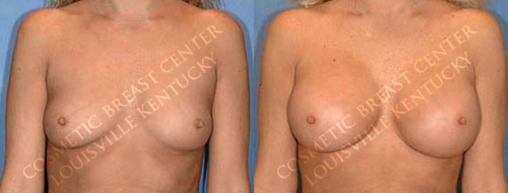 Before & After Enlargement - Saline Case 8 View #1 View in Louisville & Lexington, KY