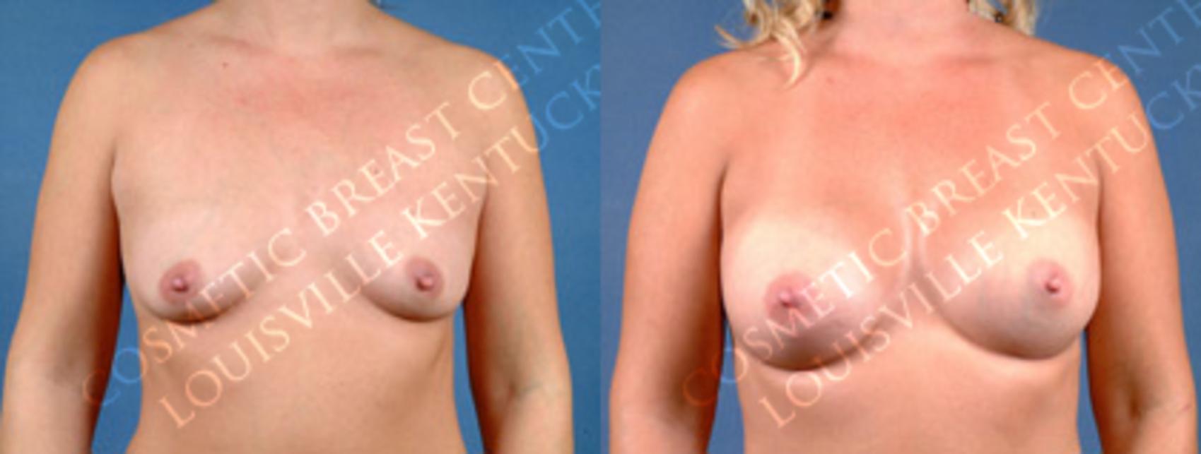 Before & After Enlargement - Silicone Case 156 View #1 View in Louisville & Lexington, KY