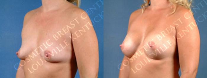 Before & After Enlargement - Silicone Case 156 View #2 View in Louisville & Lexington, KY