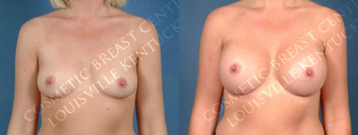 Before & After Enlargement - Silicone Case 158 View #1 View in Louisville & Lexington, KY