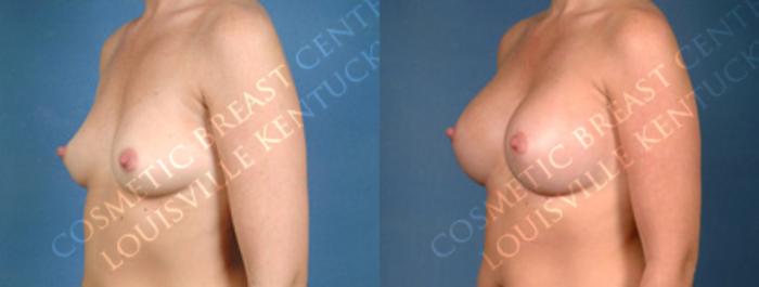 Before & After Enlargement - Silicone Case 158 View #2 View in Louisville & Lexington, KY