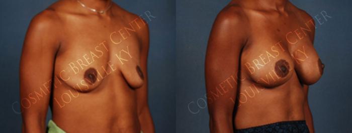 Before & After Enlargement - Silicone Case 197 View #2 View in Louisville & Lexington, KY