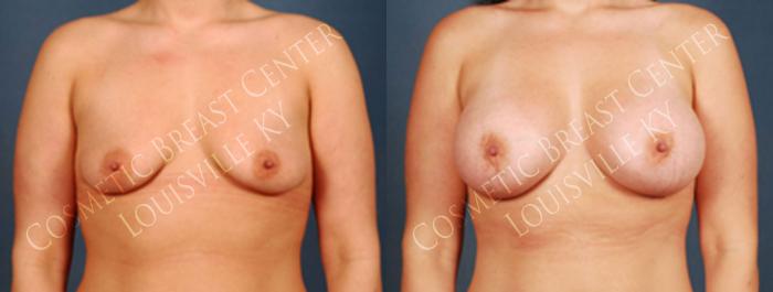 Before & After Enlargement - Silicone Case 215 View #1 View in Louisville & Lexington, KY