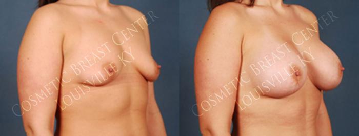 Before & After Enlargement - Silicone Case 215 View #2 View in Louisville & Lexington, KY