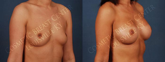 Before & After Enlargement - Silicone Case 229 View #2 View in Louisville & Lexington, KY