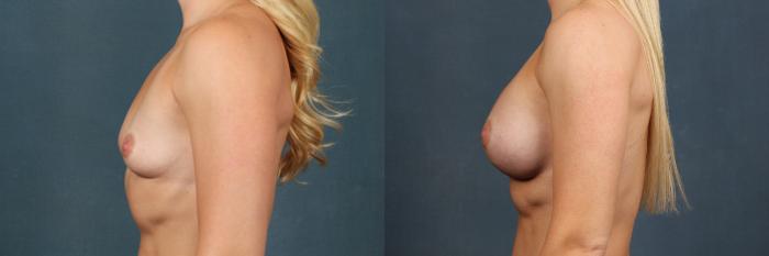 Before & After Enlargement - Silicone Case 272 View #2 View in Louisville & Lexington, KY
