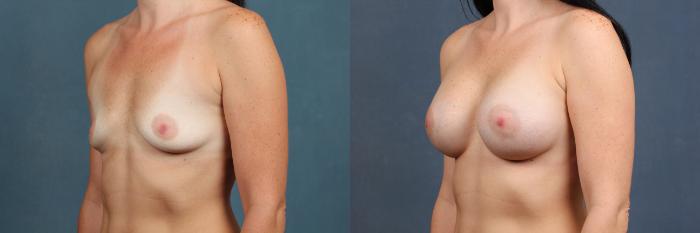 Before & After Enlargement - Silicone Case 275 View #2 View in Louisville & Lexington, KY