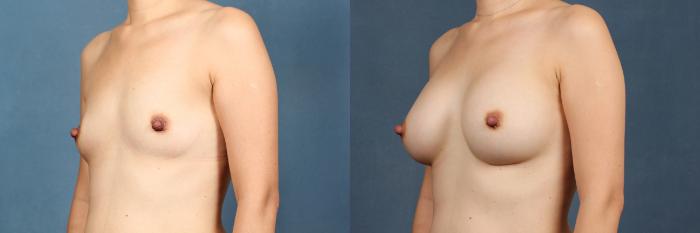 Before & After Enlargement - Silicone Case 303 View #2 View in Louisville & Lexington, KY